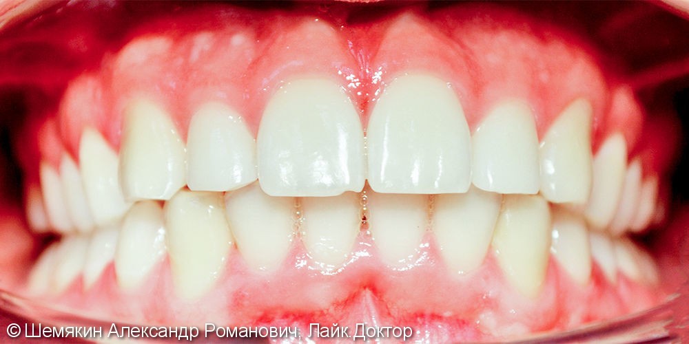 Исправление скученности зубов брекет системой Damon Q, до и результат после - фото №10