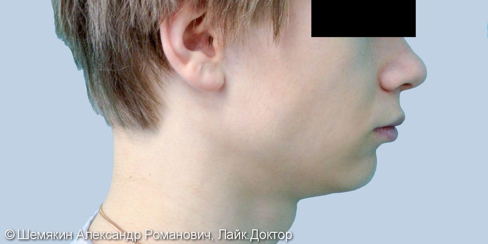 Скученность резцов верхней и нижней челюсти, до и результат после - фото №7