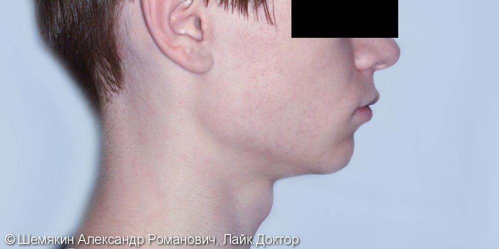 Скученность резцов верхней и нижней челюсти, до и результат после - фото №9