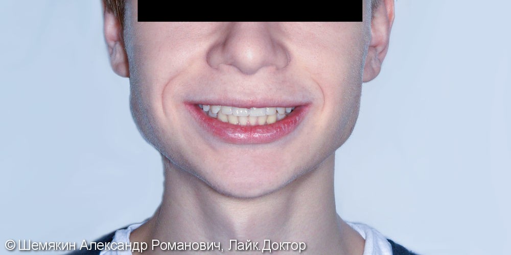 Скученность резцов верхней и нижней челюсти, до и результат после - фото №10