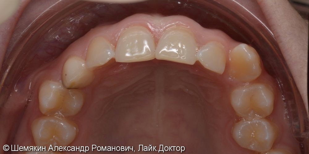Постоянный прикус, дистальное соотношение апикальных базисов и зубных рядов - фото №2