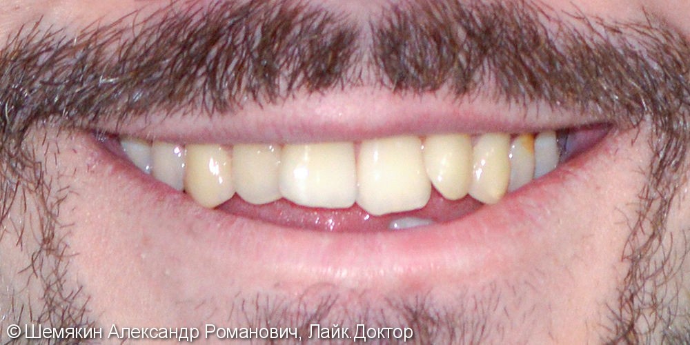 Жалобы на неправильное положение зубов и скученность на верхней и нижней челюсти - фото №1