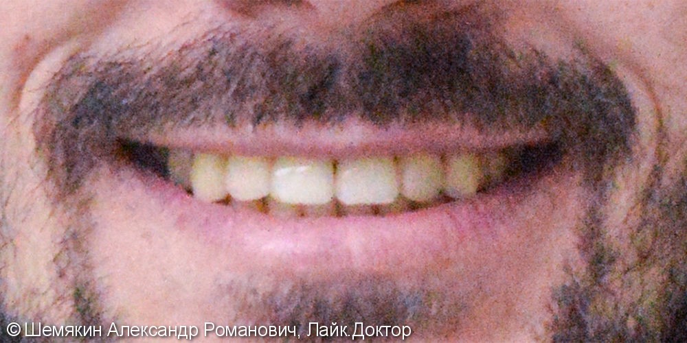 Жалобы на неправильное положение зубов и скученность на верхней и нижней челюсти - фото №14