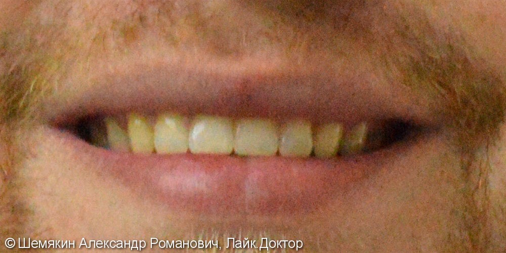 Жалобы на расстояние между зубами - фото №8