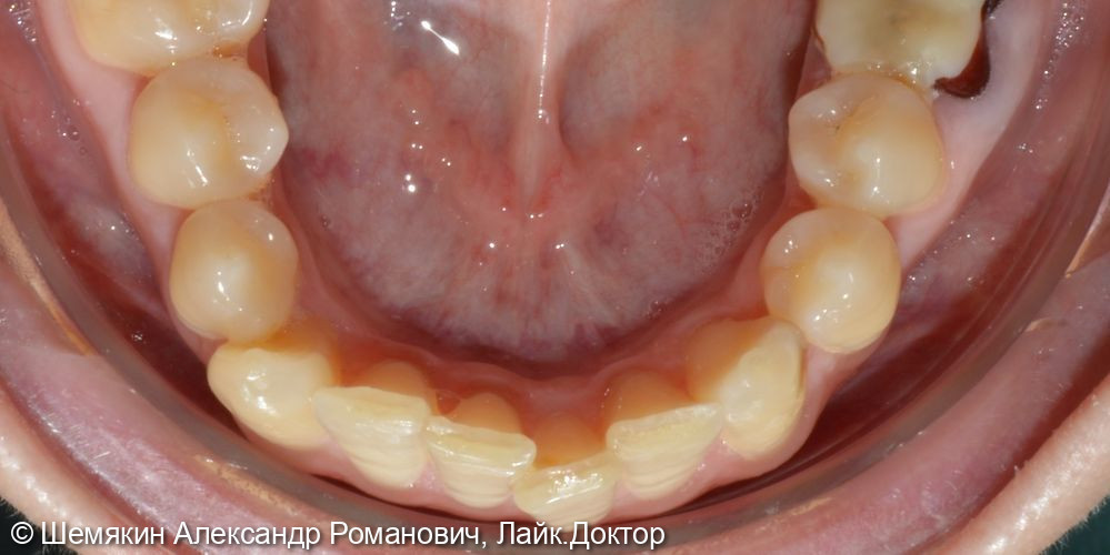 Скученность резцов на верхней и нижней челюсти - фото №5