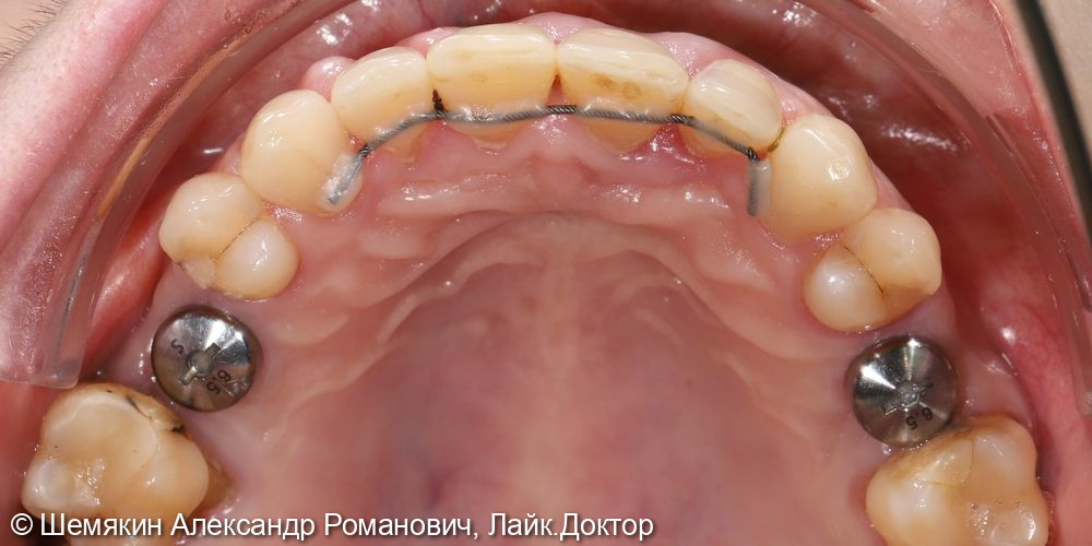 Лечение на несъемной технике Damon Q, имплантация 2 зубов - фото №2