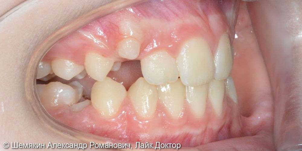 Ортодонтическое лечение - фото №3