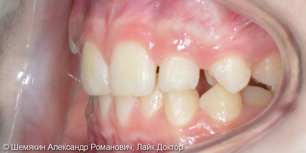 Ортодонтическое лечение - фото №4
