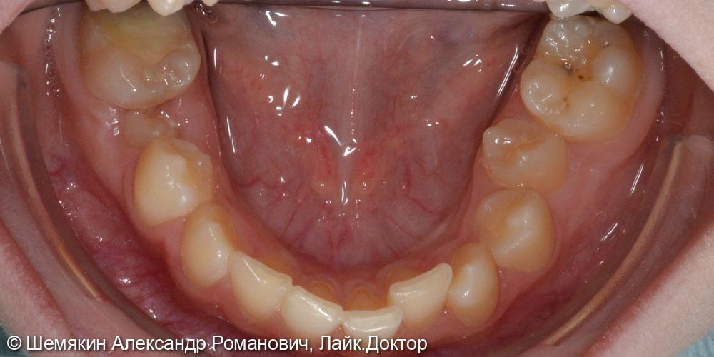 Ортодонтическое лечение - фото №6