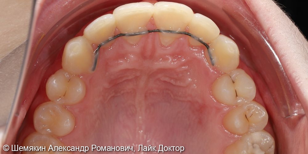Ортодонтическое лечение - фото №9