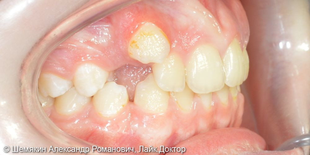Ортодонтическое лечение - фото №2