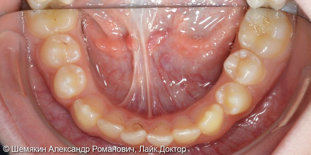 Ортодонтическое лечение - фото №5