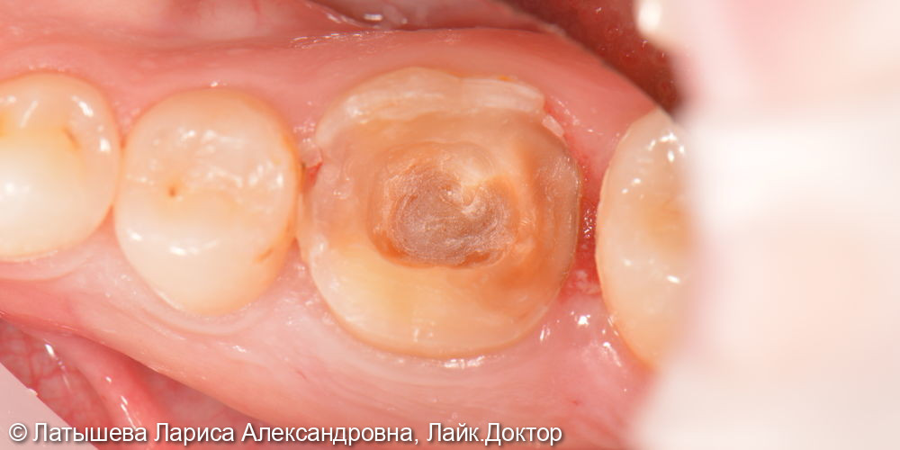 Восстановление зуба ЦЕРЕК коронкой за 1 посещение - фото №2