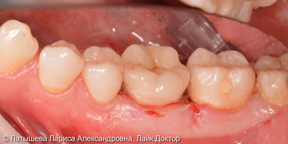 Восстановление зуба ЦЕРЕК коронкой за 1 посещение - фото №4
