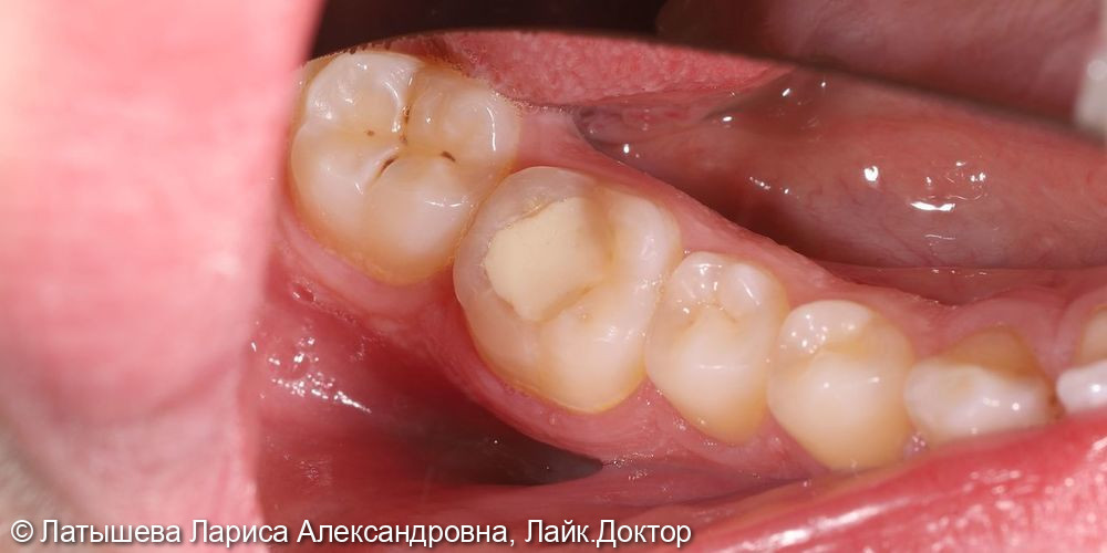 Лечение глубокого кариеса на жевательной поверхности 3.7 зуба - фото №1