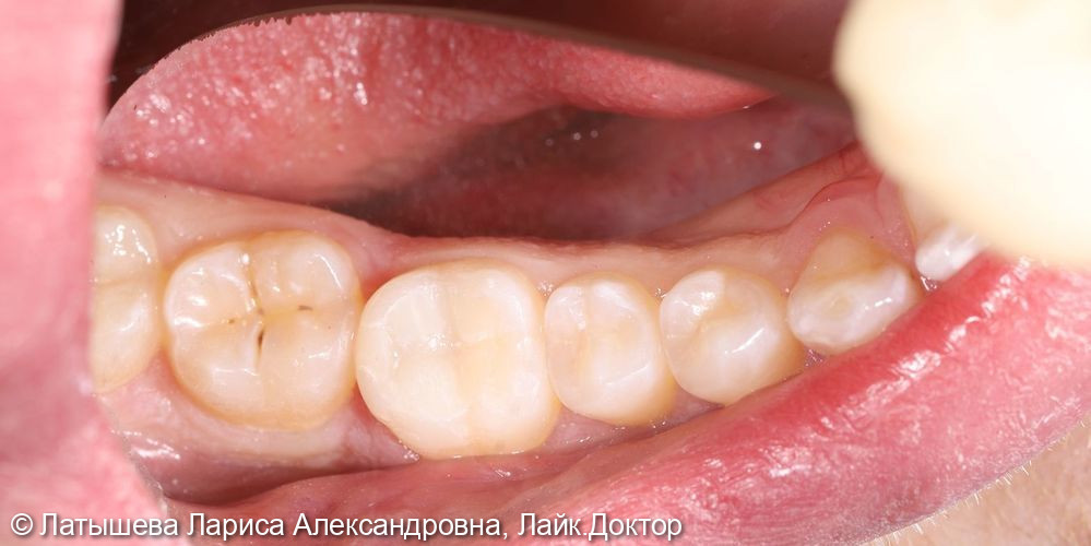 Лечение глубокого кариеса на жевательной поверхности 3.7 зуба - фото №2