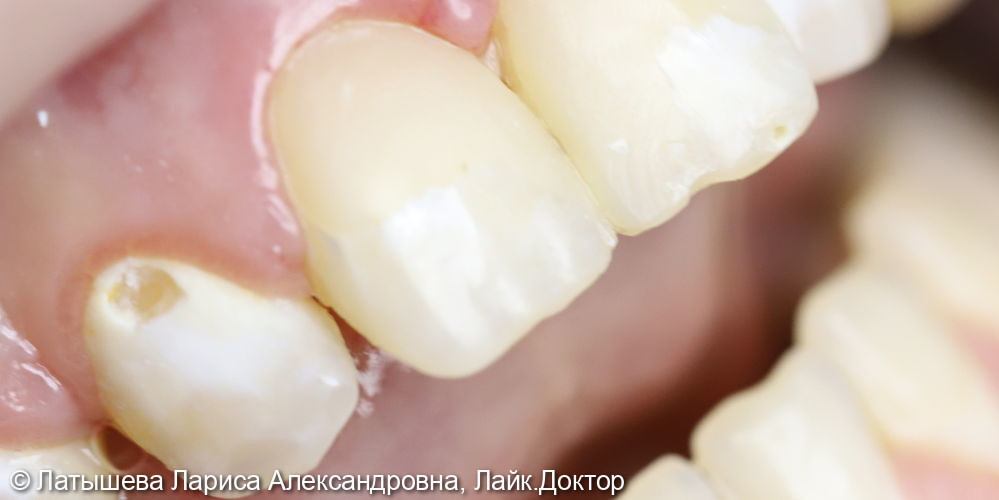 Лечение зуба 1.2. Пришеечный кариес с деминерализацией эмали на вестибулярной поверхности - фото №1
