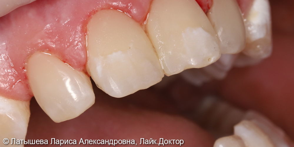 Лечение зуба 1.2. Пришеечный кариес с деминерализацией эмали на вестибулярной поверхности - фото №2