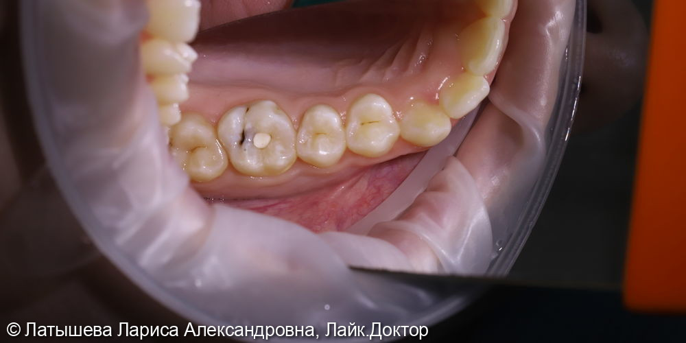 Лечение зуба 1.6 - фото №1