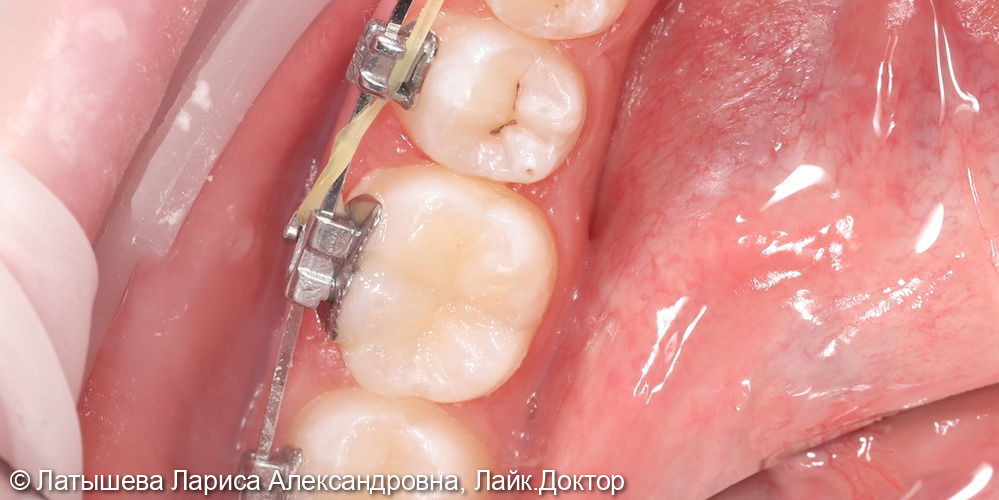 Лечение глубокого кариеса 4.6 зуба - фото №2