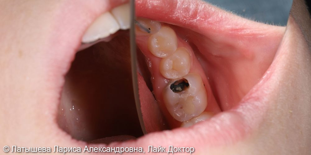 Лечение глубокого кариеса жевательного зуба - фото №1