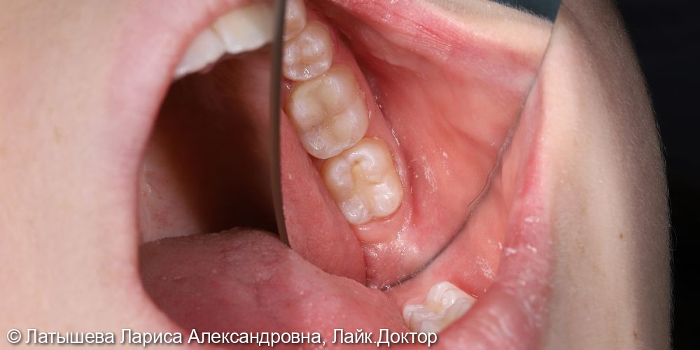 Лечение глубокого кариеса жевательного зуба - фото №2