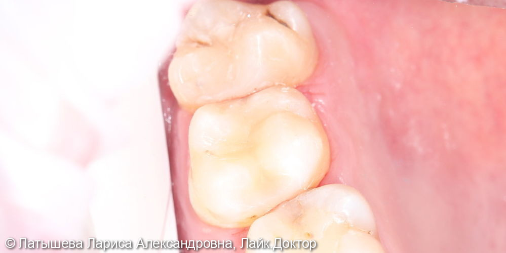 Лечение глубокого кариеса жевательного зуба 4.7 - фото №2