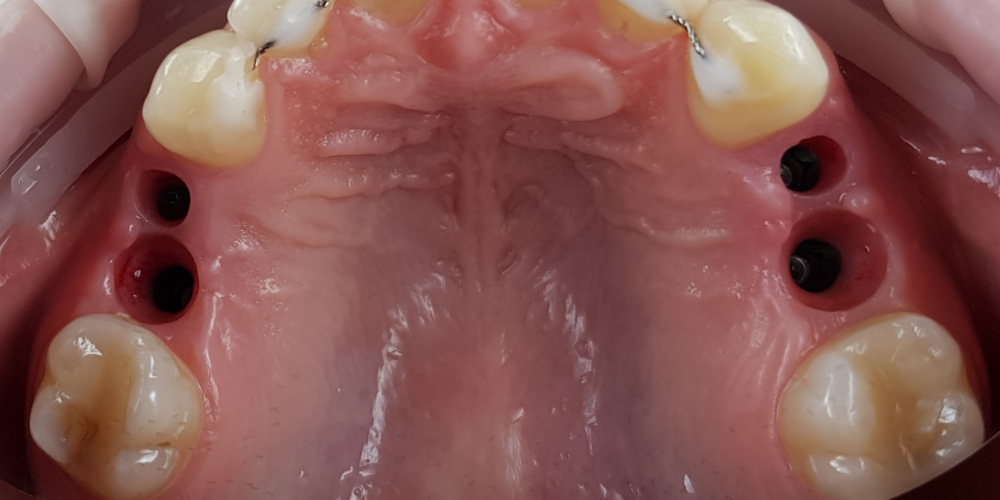 Дентальная имплантация 4х зубов, цельнокерамические коронки на имплантаты - фото №1