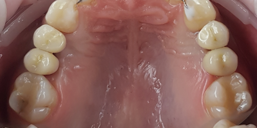 Дентальная имплантация 4х зубов, цельнокерамические коронки на имплантаты - фото №2