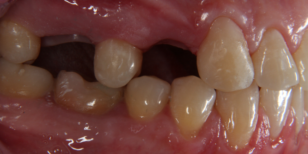 Дентальная имплантация 3х зубов на верхней челюсти - фото №1