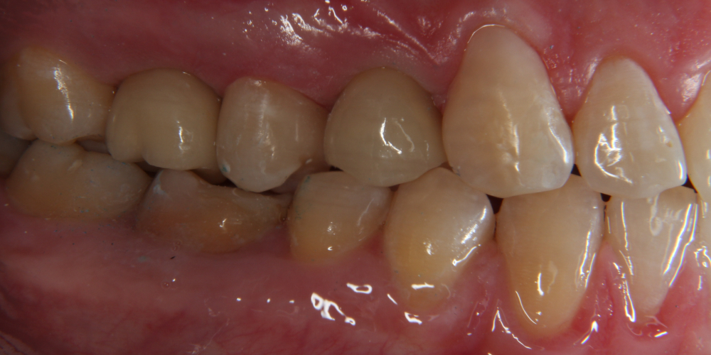Дентальная имплантация 3х зубов на верхней челюсти - фото №2