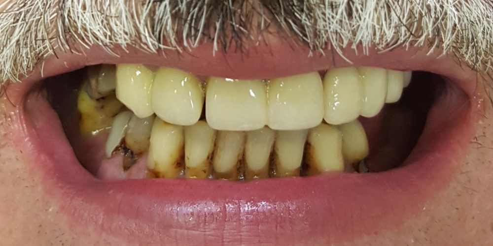 Имплантация зубов верхней и нижней челюсти, полностью - фото №1