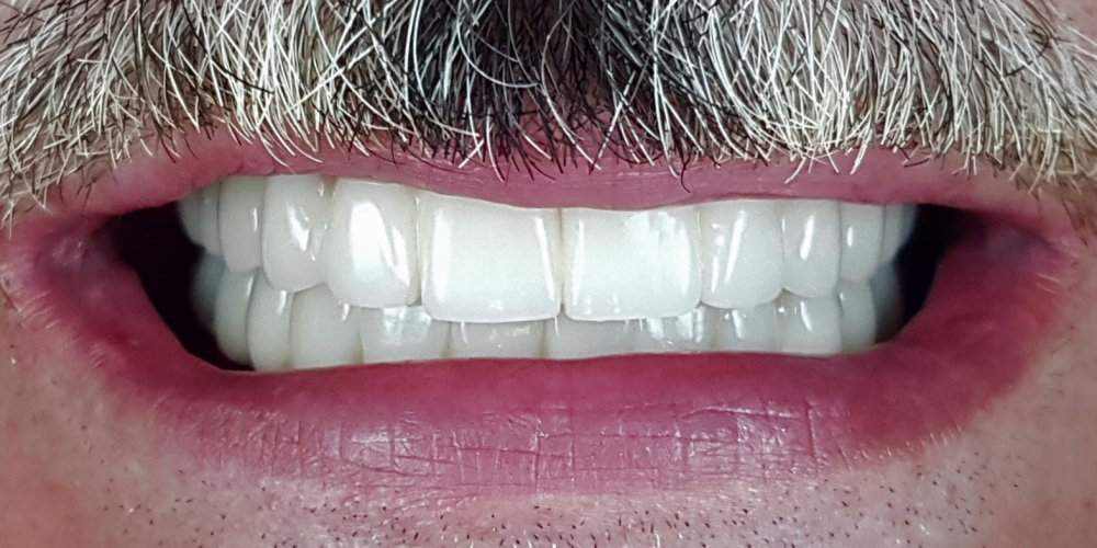 Имплантация зубов верхней и нижней челюсти, полностью - фото №2