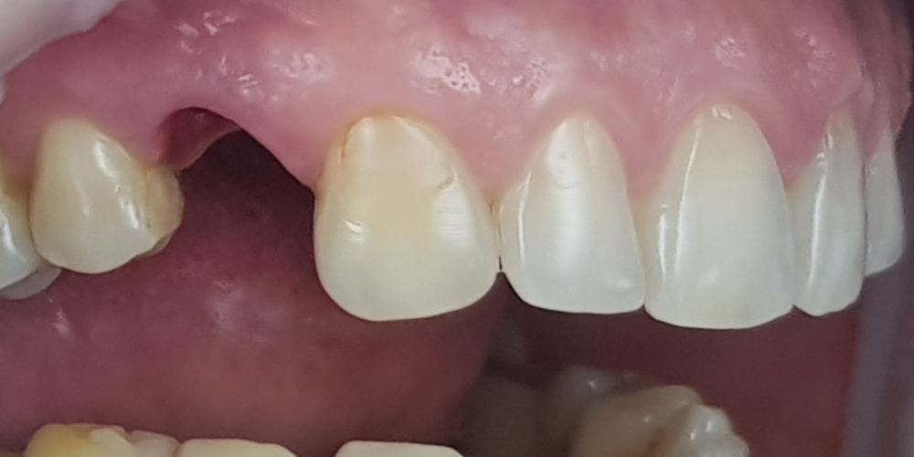 Дентальная имплантация 1 зуба на верхней челюсти, металлокерамическая коронка с опорой на имплантат - фото №1