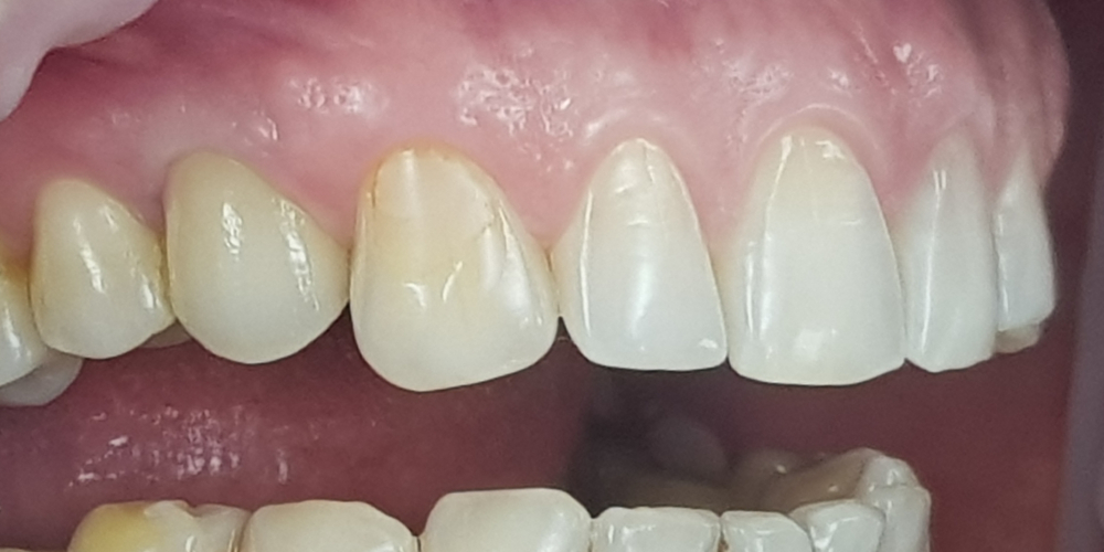 Дентальная имплантация 1 зуба на верхней челюсти, металлокерамическая коронка с опорой на имплантат - фото №2