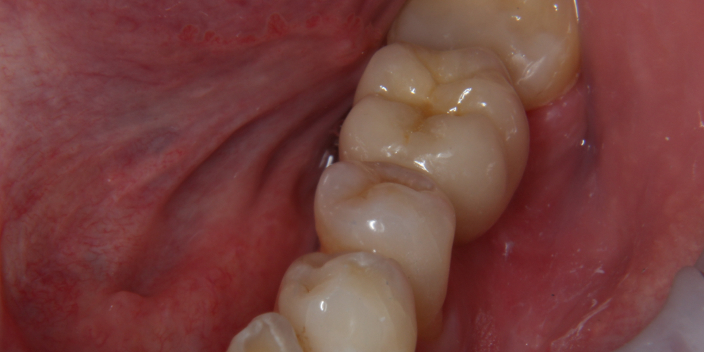 Дентальная имплантация 1 зуба на нижней челюсти, металлокерамическая коронка с опорой на имплант - фото №2