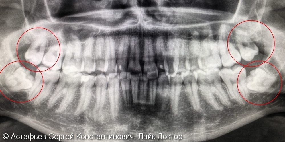 Удаление четырех зубов мудрости перед ортодонтическим лечением - фото №1