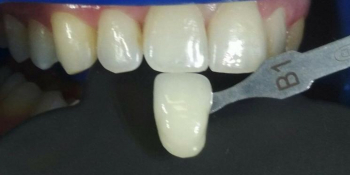 Клиническое отбеливание зубов системой ZOOM4 - фото №1