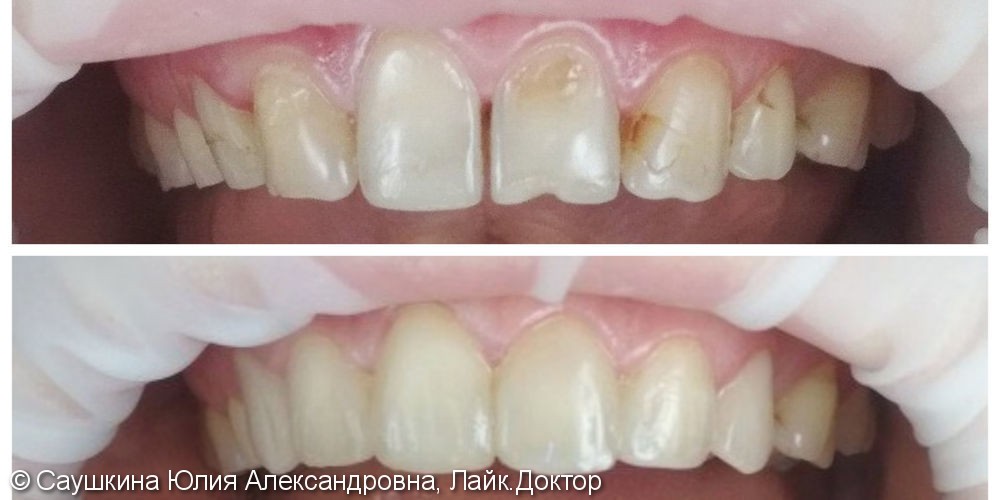 Лечение фронтальных зубов верхней челюсти, до и после - фото №1