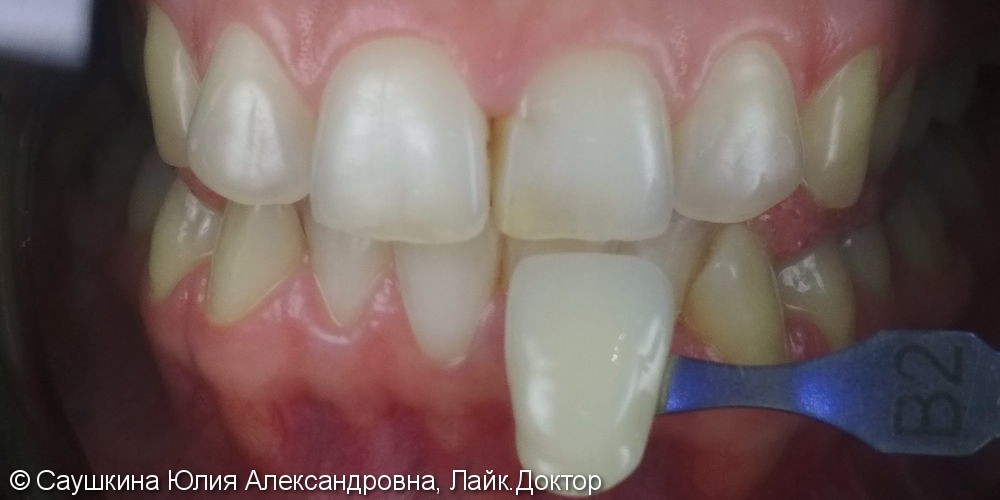 Отбеливание зубов ZOOM 4, до и после - фото №1