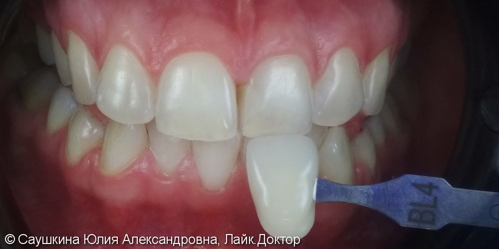 Отбеливание зубов ZOOM 4, до и после - фото №2