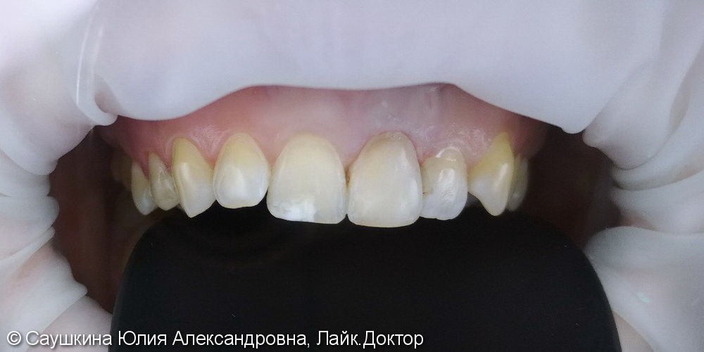 Эндокональное отбеливание и реставрация зуба - фото №2