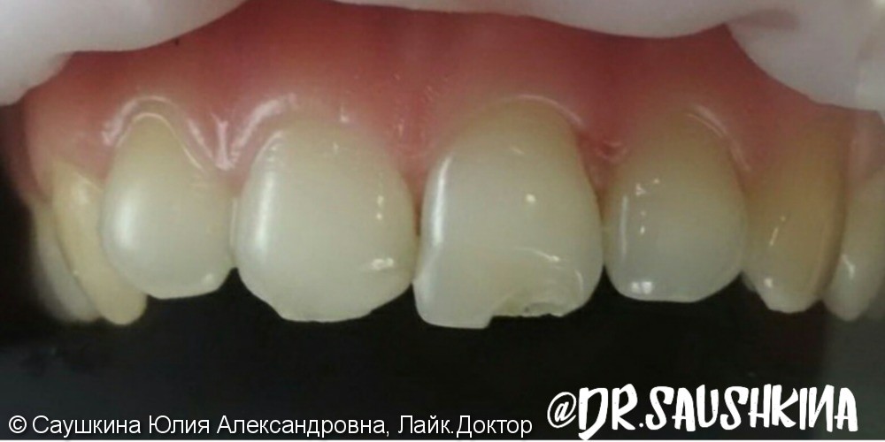 Реставрация фронтальной группы зубов материалом Estelite Asteria - фото №1