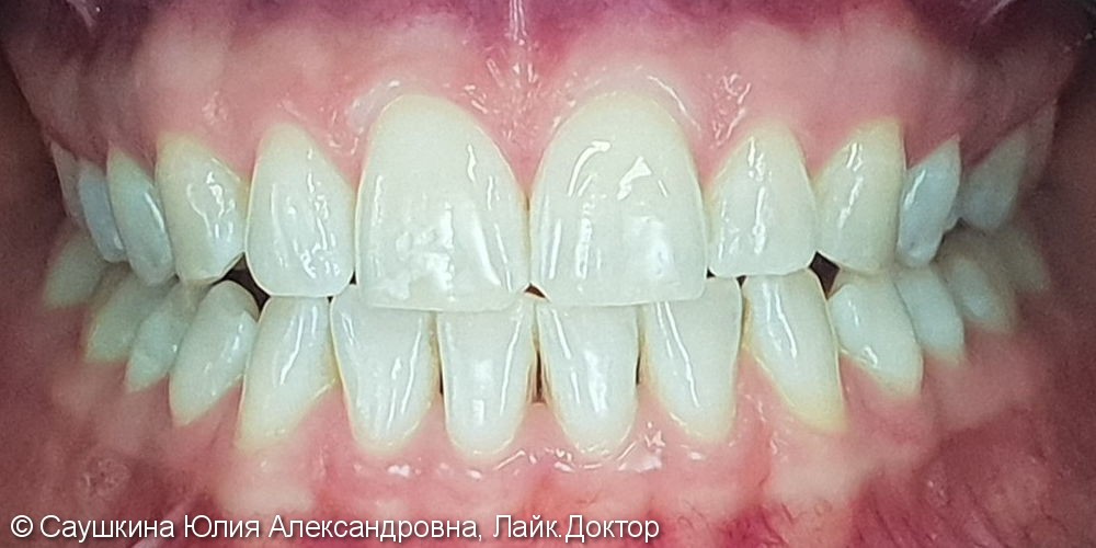 Отбеливание зубов ZOOM-4, до и результат после - фото №2