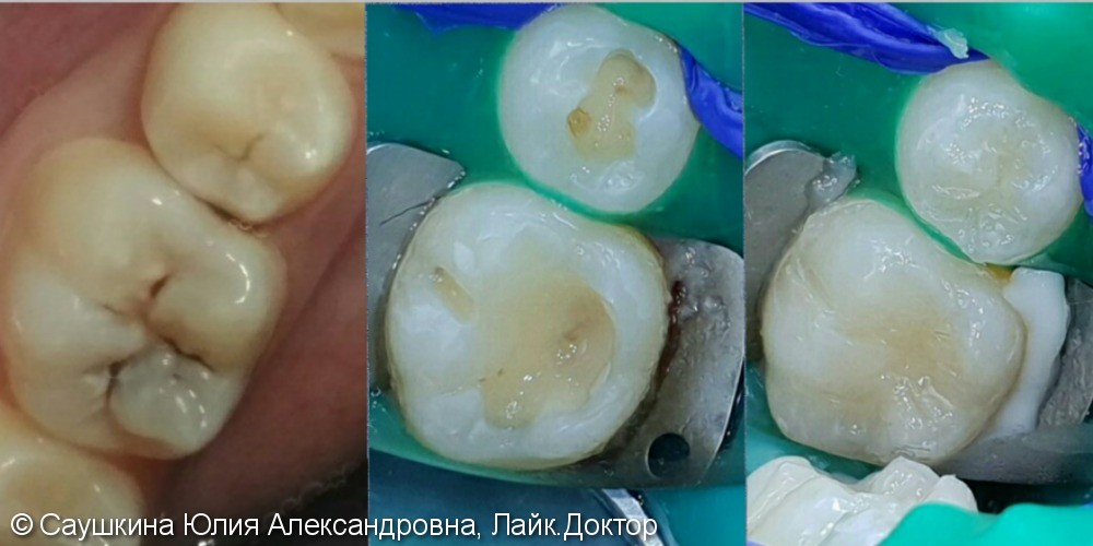 Лечение кариеса на 2-х зубах, до и результат после - фото №1