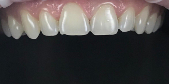 Результат реставрации и отбеливания зубов ZOOM 4 - фото №1
