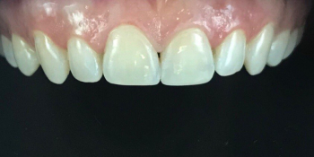 Результат реставрации и отбеливания зубов ZOOM 4 - фото №2