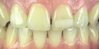 Реставрация зуба 21 и домашнее отбеливание - фото №1
