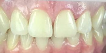 Реставрация зуба 21 и домашнее отбеливание - фото №2