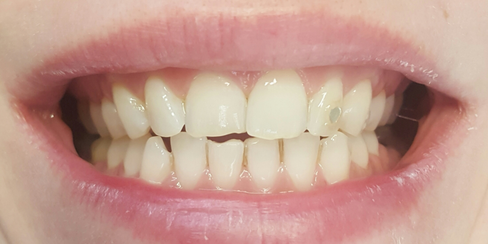 Цельнокерамические виниры E-max на передние зубы верхней и нижней челюсти, домашнее отбеливание - фото №1